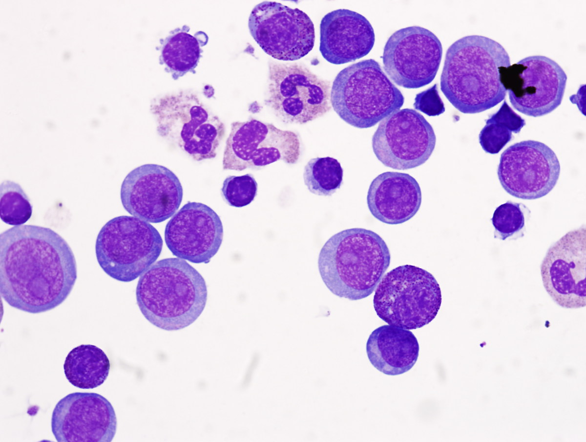 Cytospin preparation of peripheral blood sample